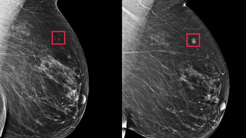人工智能如何推动乳腺癌预测